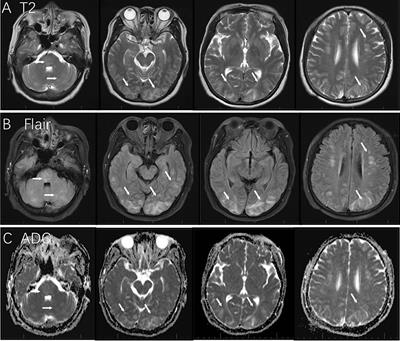 Posterior Reversible Encephalopathy Syndrome Associated With Anlotinib: A Case Report and Literature Review